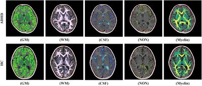 Brain Volumetric Measurements in Children With Attention Deficit Hyperactivity Disorder: A Comparative Study Between Synthetic and Conventional Magnetic Resonance Imaging